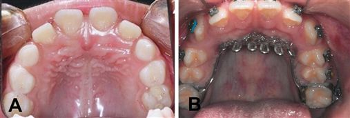 Tratamento Da Mordida Aberta Anterior Com Grade Palatina Fixa Relato Tratamento Da Mordida Aberta Anterior Com Grade Palatina Fixa Relato